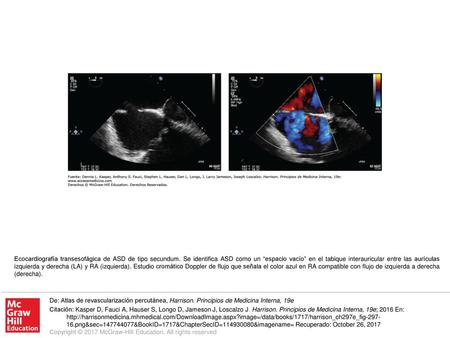 Ecocardiografía transesofágica de ASD de tipo secundum