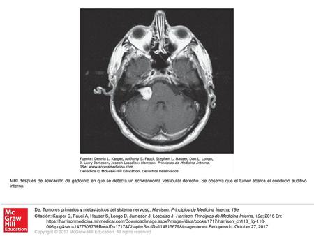 MRI después de aplicación de gadolinio en que se detecta un schwannoma vestibular derecho. Se observa que el tumor abarca el conducto auditivo interno.