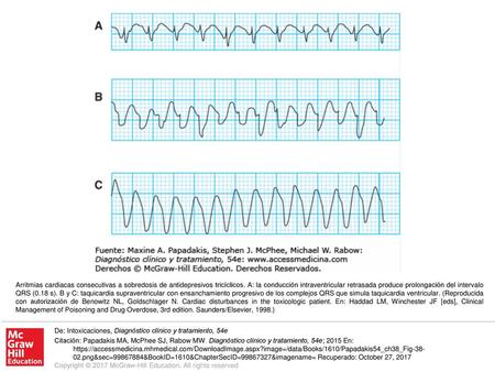 Arritmias cardiacas consecutivas a sobredosis de antidepresivos tricíclicos. A: la conducción intraventricular retrasada produce prolongación del intervalo.