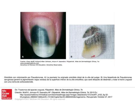 Onicólisis con colonización por Pseudomonas