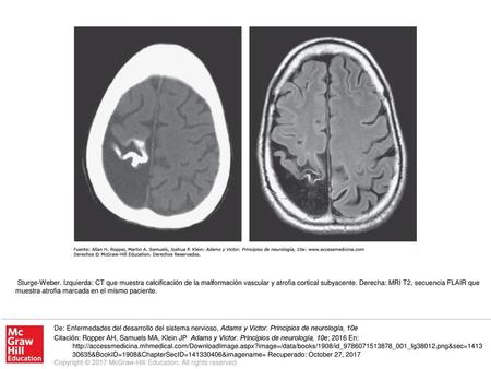 Sturge-Weber. Izquierda: CT que muestra calcificación de la malformación vascular y atrofia cortical subyacente. Derecha: MRI T2, secuencia FLAIR que muestra.