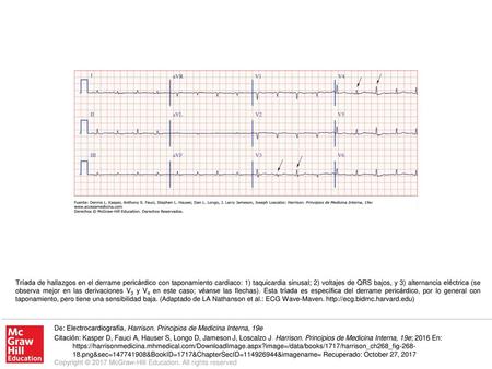 Tríada de hallazgos en el derrame pericárdico con taponamiento cardiaco: 1) taquicardia sinusal; 2) voltajes de QRS bajos, y 3) alternancia eléctrica (se.
