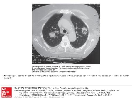 Neumonía por Nocardia. Un estudio de tomografía computarizada muestra nódulos bilaterales, con formación de una cavidad en el nódulo del pulmón izquierdo.