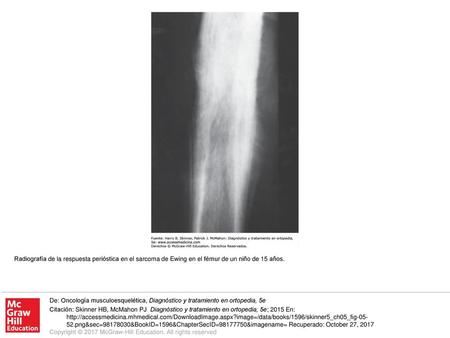 Radiografía de la respuesta perióstica en el sarcoma de Ewing en el fémur de un niño de 15 años. De: Oncología musculoesquelética, Diagnóstico y tratamiento.