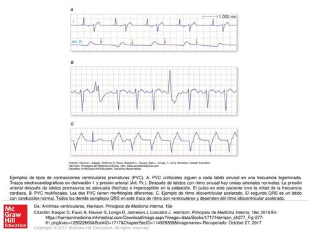 Ejemplos de tipos de contracciones ventriculares prematuras (PVC). A