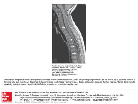 Resonancia magnética de una siringomielia asociada con una malformación de Chiari. Imagen sagital ponderada en T1 a nivel de la columna cervical y torácica.