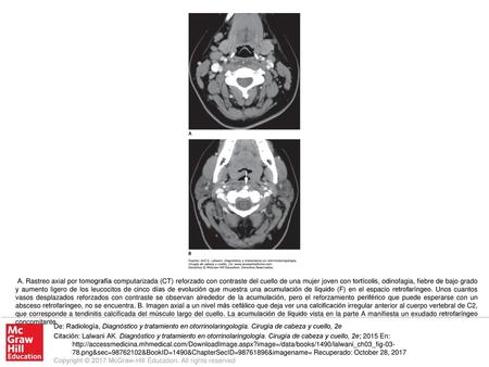 A. Rastreo axial por tomografía computarizada (CT) reforzado con contraste del cuello de una mujer joven con tortícolis, odinofagia, fiebre de bajo grado.