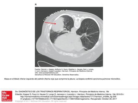 Masa en el lóbulo inferior izquierdo del pulmón (flecha roja) que comprime la pleura. La biopsia confirmó carcinoma pulmonar microcítico. De: DIAGNÓSTICO.