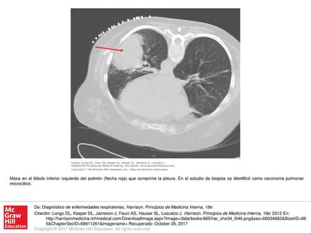Masa en el lóbulo inferior izquierdo del pulmón (flecha roja) que comprime la pleura. En el estudio de biopsia se identificó como carcinoma pulmonar microcítico.