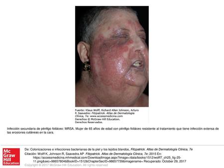 Infección secundaria de pénfigo foliáceo: MRSA