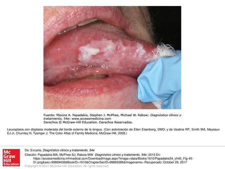 Leucoplasia con displasia moderada del borde externo de la lengua