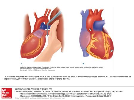 A. Se utiliza una pinza de Satinsky para ocluir el hilio pulmonar con el fin de evitar la embolia broncovenosa adicional. B. Los sitios secuenciales de.