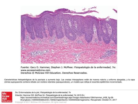 Características histopatológicas de la psoriasis a aumento bajo