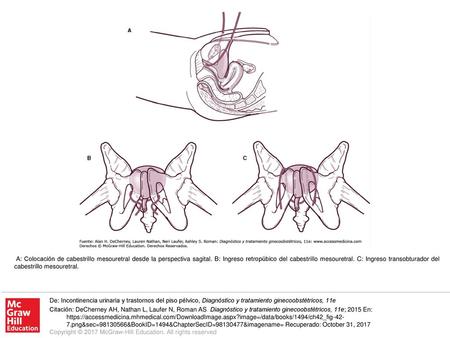 A: Colocación de cabestrillo mesouretral desde la perspectiva sagital