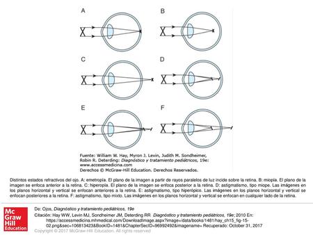 Distintos estados refractivos del ojo. A: emetropía