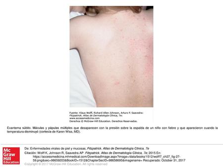 Exantema súbito. Máculas y pápulas múltiples que desaparecen con la presión sobre la espalda de un niño con fiebre y que aparecieron cuando la temperatura.