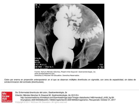 Colon por enema en proyección anteroposterior en el que se observan múltiples divertículos en sigmoide, con zona de espasticidad, sin datos de extraluminizacion.