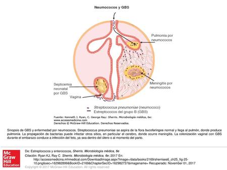 Sinopsis de GBS y enfermedad por neumococos