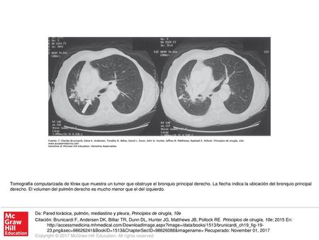 Tomografía computarizada de tórax que muestra un tumor que obstruye el bronquio principal derecho. La flecha indica la ubicación del bronquio principal.