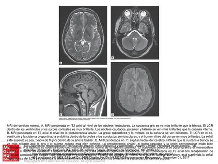 MRI del cerebro normal. A