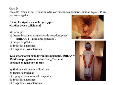 Caso 24 Paciente femenina de 18 años de edad con amenorrea primaria, estatura baja (1.45 cm) y clitoromegalia. 1. Con los siguientes hallazgos, ¿qué estudios.