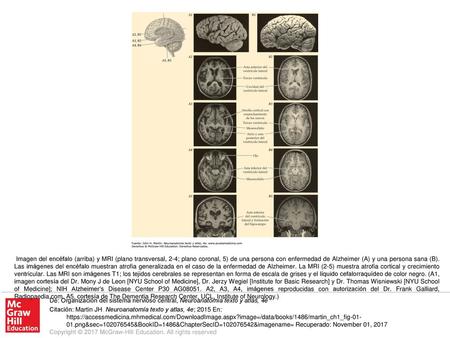 Imagen del encéfalo (arriba) y MRI (plano transversal, 2-4; plano coronal, 5) de una persona con enfermedad de Alzheimer (A) y una persona sana (B). Las.