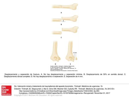 Desplazamiento y separación de fractura. A