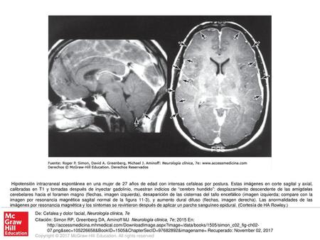 Hipotensión intracraneal espontánea en una mujer de 27 años de edad con intensas cefaleas por postura. Estas imágenes en corte sagital y axial, calibradas.