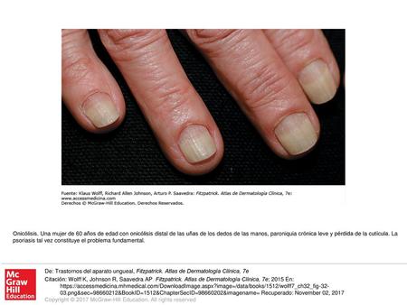 Onicólisis. Una mujer de 60 años de edad con onicólisis distal de las uñas de los dedos de las manos, paroniquia crónica leve y pérdida de la cutícula.