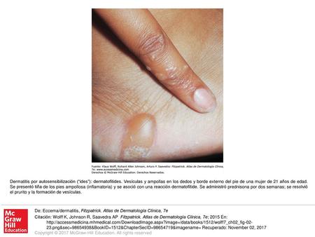 Dermatitis por autosensibilización (“ides”): dermatofítides