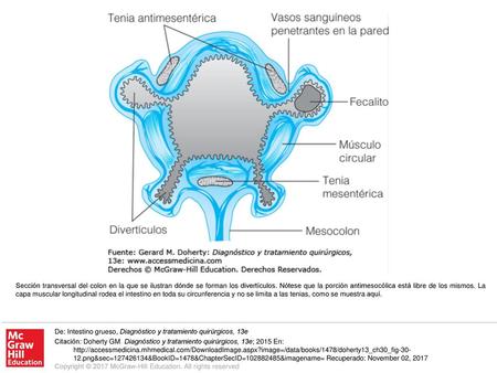 Sección transversal del colon en la que se ilustran dónde se forman los divertículos. Nótese que la porción antimesocólica está libre de los mismos. La.