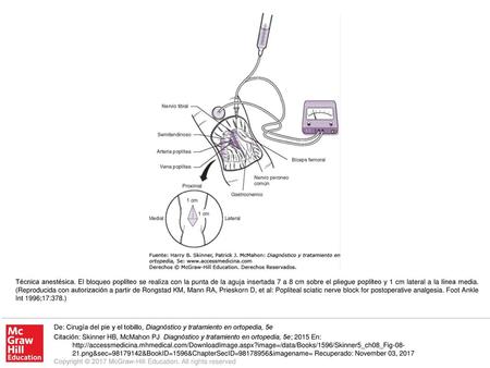 Técnica anestésica. El bloqueo poplíteo se realiza con la punta de la aguja insertada 7 a 8 cm sobre el pliegue poplíteo y 1 cm lateral a la línea media.