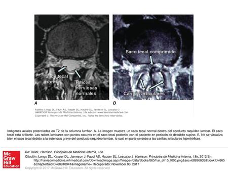 Imágenes axiales potenciadas en T2 de la columna lumbar. A