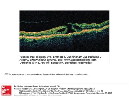 OCT del agujero macular que muestra edema y desprendimiento del revestimiento que circunda la retina. De: Retina, Vaughan y Asbury. Oftalmología general,