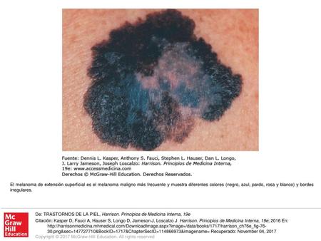 El melanoma de extensión superficial es el melanoma maligno más frecuente y muestra diferentes colores (negro, azul, pardo, rosa y blanco) y bordes irregulares.