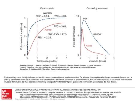Espirometria y curva de flujo/volumen en asmáticos en comparación con sujetos normales. Se advierte disminución del volumen espiratorio forzado en 1 s.