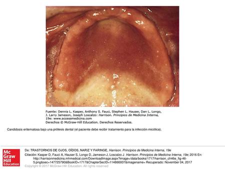Candidosis eritematosa bajo una prótesis dental (el paciente debe recibir tratamiento para la infección micótica). De: TRASTORNOS DE OJOS, OÍDOS, NARIZ.