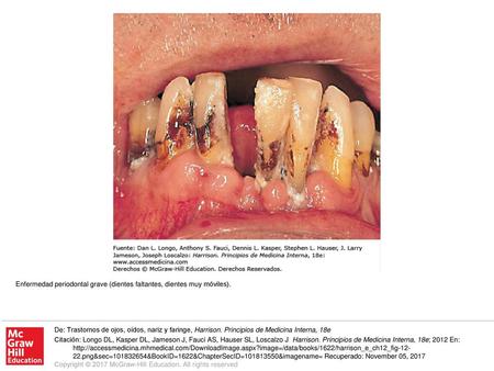 Enfermedad periodontal grave (dientes faltantes, dientes muy móviles).