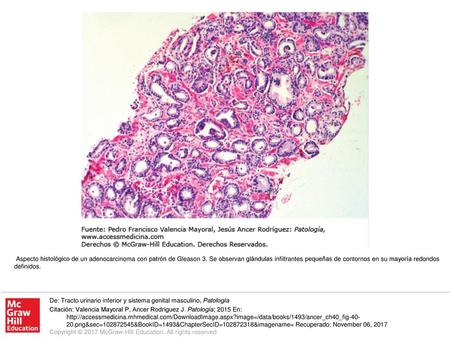 Aspecto histológico de un adenocarcinoma con patrón de Gleason 3