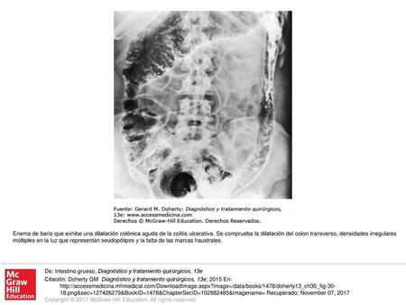 Enema de bario que exhibe una dilatación colónica aguda de la colitis ulcerativa. Se comprueba la dilatación del colon transverso, densidades irregulares.