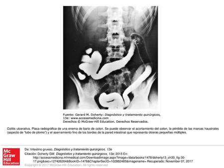 Colitis ulcerativa. Placa radiográfica de una enema de bario de colon
