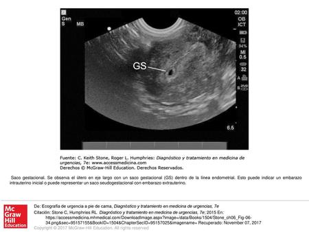 Saco gestacional. Se observa el útero en eje largo con un saco gestacional (GS) dentro de la línea endometrial. Esto puede indicar un embarazo intrauterino.
