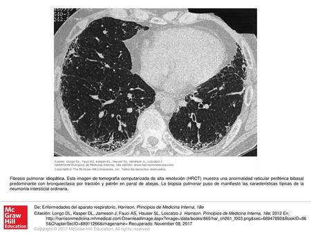 Fibrosis pulmonar idiopática