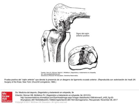 Prueba positiva del “cajón anterior” que denota la presencia de un desgarro de ligamento cruzado anterior. (Reproducida con autorización de Insall JN: