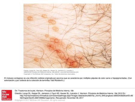 El molusco contagioso es una infección cutánea originada por poxvirus que se caracteriza por múltiples pápulas de color carne o hipopigmentadas. (Con autorización.
