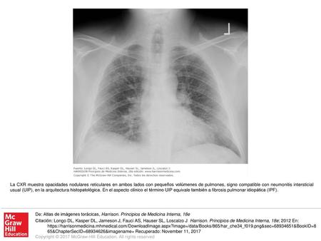 La CXR muestra opacidades nodulares reticulares en ambos lados con pequeños volúmenes de pulmones, signo compatible con neumonitis intersticial usual (UIP),