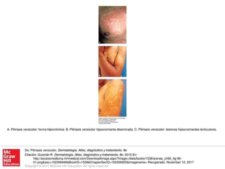 A. Pitiriasis versicolor: forma hipocrómica. B