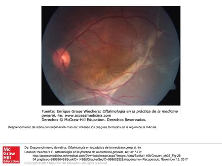 Desprendimiento de retina con implicación macular; nótense los pliegues formados en la región de la mácula. De: Desprendimiento de retina, Oftalmología.