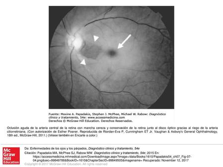 Oclusión aguda de la arteria central de la retina con mancha cereza y conservación de la retina junto al disco óptico gracias al riego de la arteria ciliorretiniana.