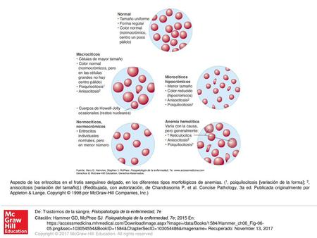 Aspecto de los eritrocitos en el frotis sanguíneo delgado, en los diferentes tipos morfológicos de anemias. (1, poiquilocitosis [variación de la forma];